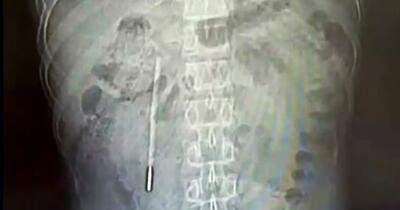 Ce au găsit medicii în stomacul unui bărbat: secretul păstrat 20 de ani