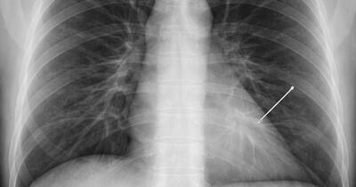 O femeie a trăit 30 de ani cu un ac în plămân fără să știe. Descoperirea l-a șocat pe un reputat medic: „Am înghețat”