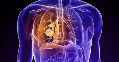 Combinația de medicamente care scade cu 58% riscul de deces în cancerul pulmonar