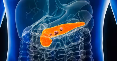 O pastilă experimentală a redus tumorile la 41% dintre pacienții cu cancer pancreatic